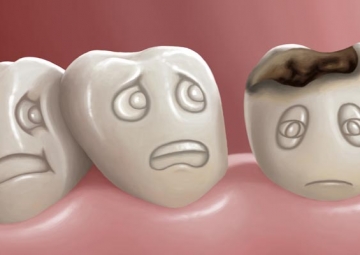 Diş Çürüğünün Nedenleri ve Belirtileri Nelerdir?